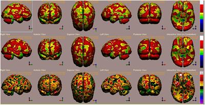 Recovery of Repressed Memories in Fibromyalgia Patients Treated With Hyperbaric Oxygen – Case Series Presentation and Suggested Bio-Psycho-Social Mechanism